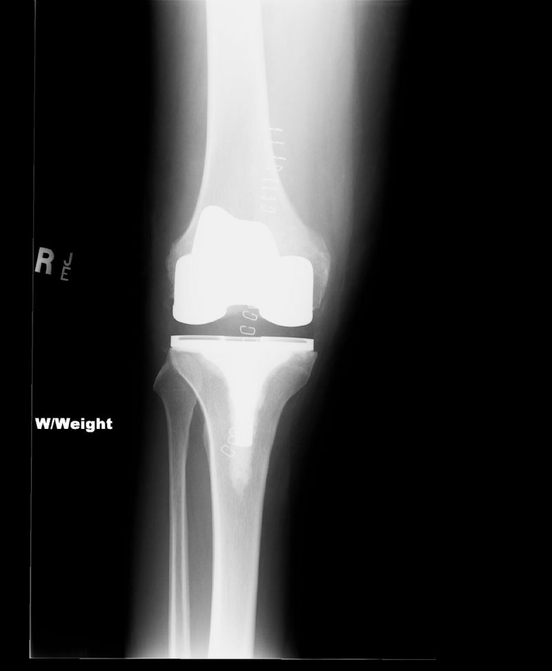 Smith & Nephew Journey (Implant 4223)